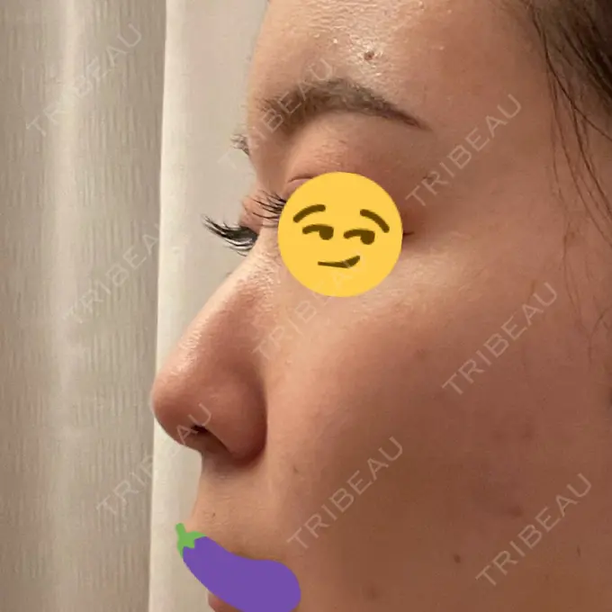 隆鼻術 ヤスミクリニック BEFORE メイン用