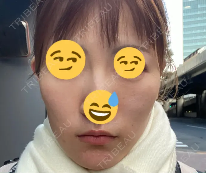 フォトRF リアルクリニック（REAL CLINIC） BEFORE メイン用