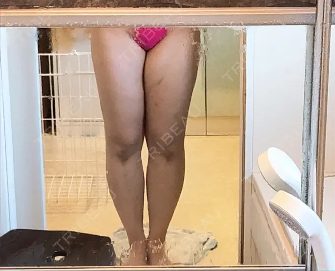 脂肪吸引（脚） / 脂肪吸引（お尻） / その他（ボディ） 湘南美容クリニック 名古屋院 BEFORE メイン用