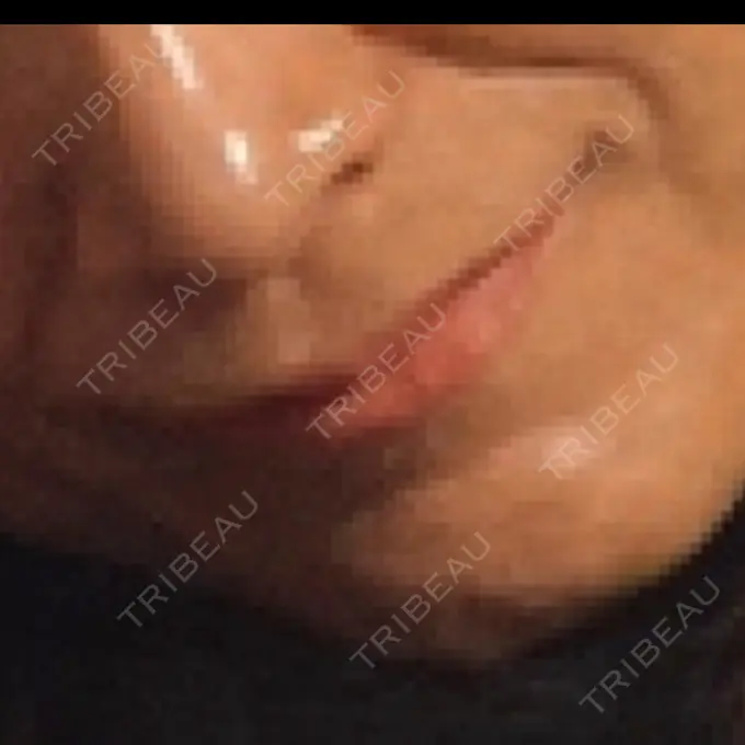 ヒアルロン酸注入（唇） / ボトックス（口角） フィラークリニック 名古屋栄院 BEFORE メイン用