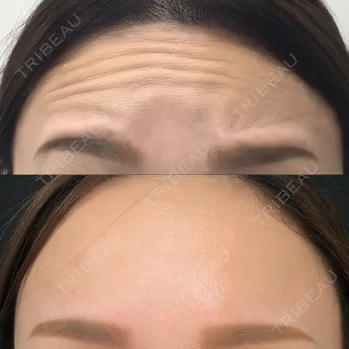 シワ取りボトックス 渋谷美容外科クリニック 新宿院 BEFORE メイン用