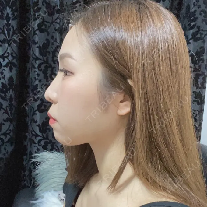 糸リフト / あごプロテーゼ / 脂肪吸引（顔） 湘南美容クリニック 上野院 BEFORE メイン用