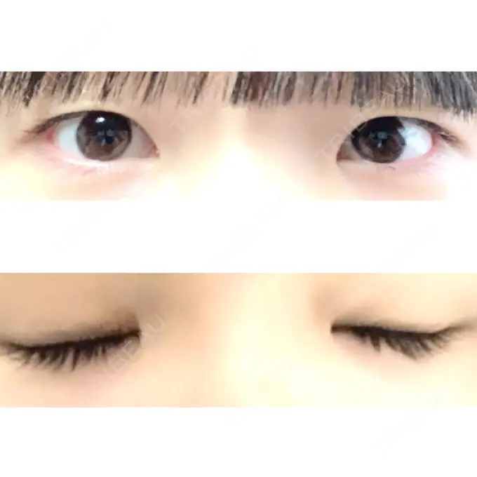 二重埋没 ハナビューティークリニック BEFORE メイン用