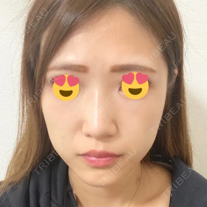 脂肪溶解注射（顔） 新宿美容外科クリニック 新宿院 BEFORE メイン用