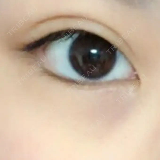 目尻切開 / タレ目形成・グラマラスライン（切開） / 目尻靭帯移動 FROM B整形外科 (旧バウム整形外科) BEFORE メイン用