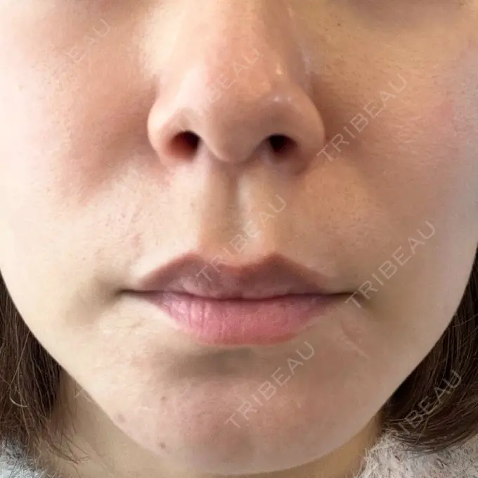 人中短縮 新宿ラクル美容外科クリニック 新宿院 BEFORE メイン用