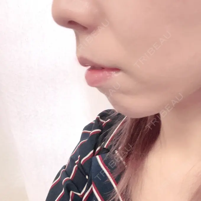 あごプロテーゼ 新宿TAクリニック BEFORE メイン用