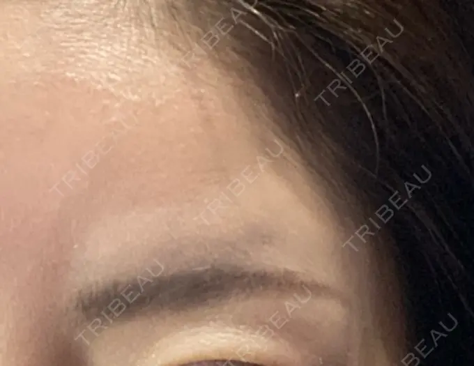 ボトックス（額） TCB東京中央美容外科 千葉駅前院 BEFORE メイン用