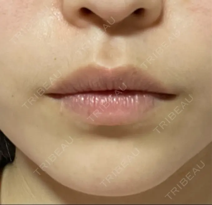 アートメイク（唇） 筋肉・美容クリニック BEFORE メイン用