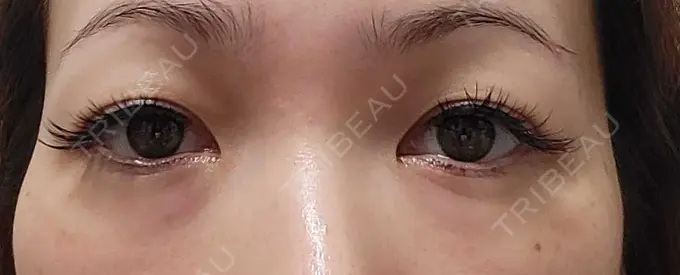 下まぶたたるみ取り / 下まぶたの脂肪取り 品川スキンクリニック広島院 BEFORE メイン用