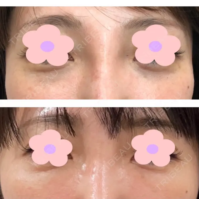 脂肪注入（目の下） 渋谷美容外科クリニック 新橋院 BEFORE メイン用