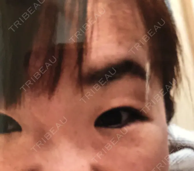 眼瞼下垂（切開） 滋賀美容皮膚科クリニック BEFORE メイン用