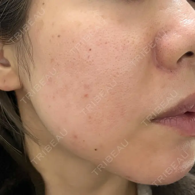 フォトシルクプラス KM新宿クリニック BEFORE メイン用