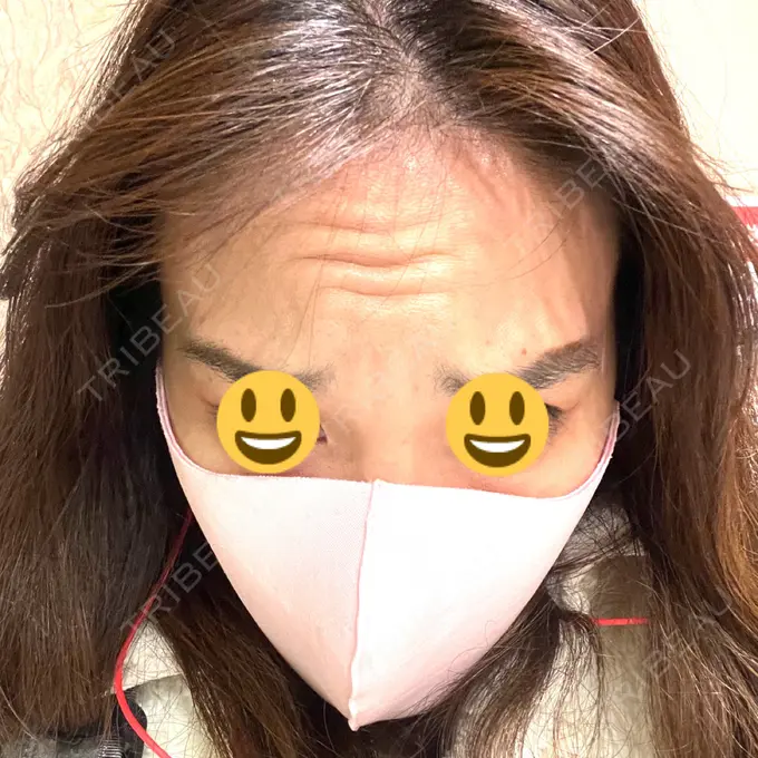 マイクロボトックス / ボトックス（額） / その他（輪郭） ルラ美容クリニック 新宿院 BEFORE メイン用