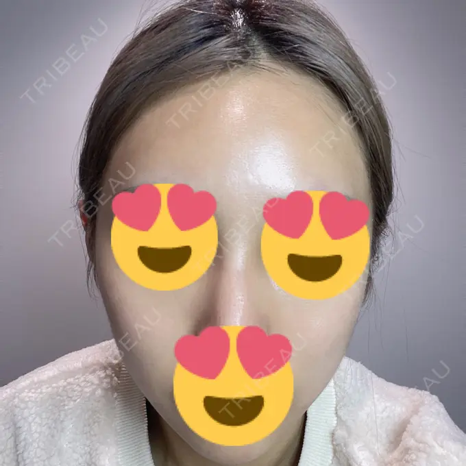 イオン導入 / レーザートーニング（美白・肝斑） / ピーリング（ハリ・ツヤ） 新宿美容外科クリニック 立川院 BEFORE メイン用