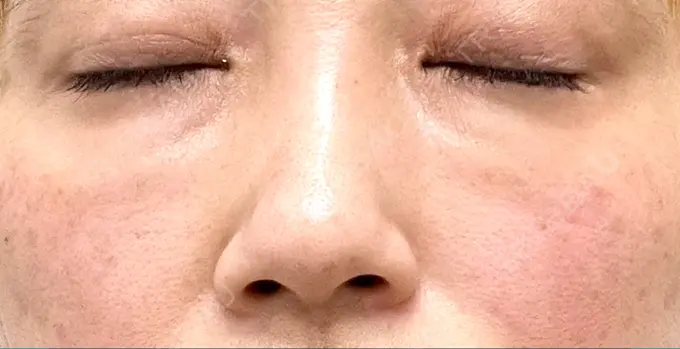 レーザートーニング（美白・肝斑） 銀座美容外科クリニック 銀座院 BEFORE メイン用