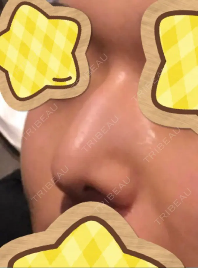 ヒアルロン酸注入（鼻） 恵聖会クリニック 京橋院 BEFORE メイン用