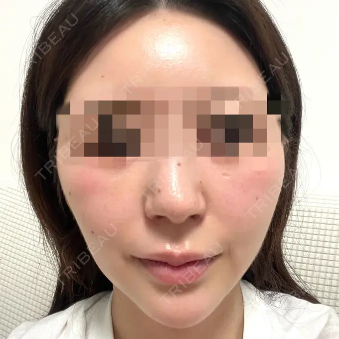 ほくろ・いぼ切除（肌） エースクリニック 大阪梅田HEPナビオ院 BEFORE メイン用