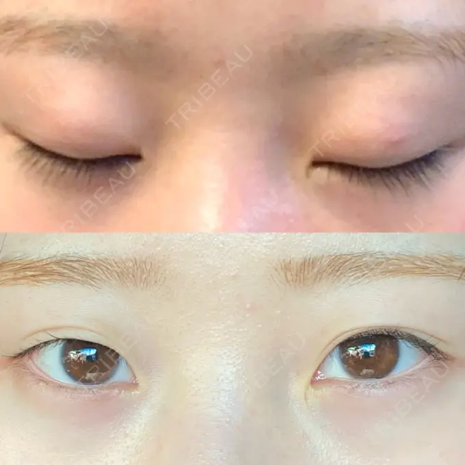 二重埋没 大西皮フ科形成外科医院 滋賀大津石山院 BEFORE メイン用