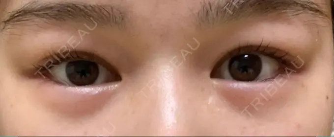 眉下切開 / 眼瞼下垂（非切開） 大塚美容形成外科 銀座本院 BEFORE メイン用
