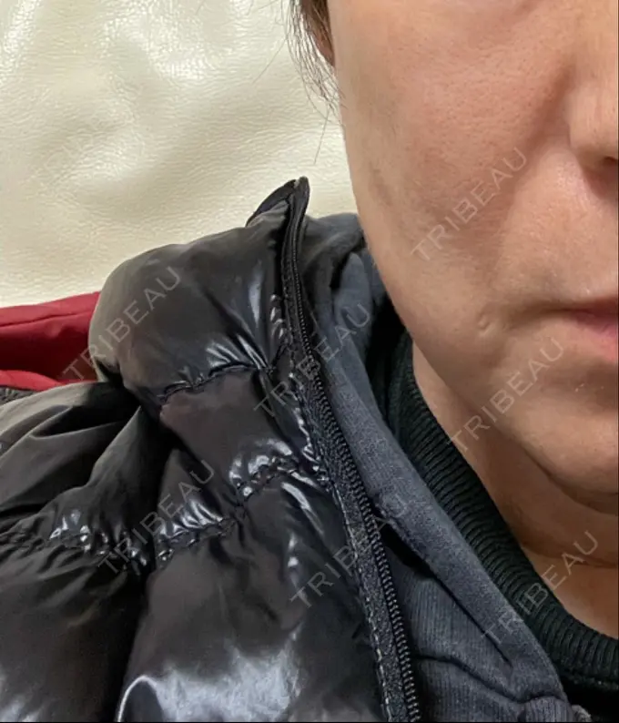 ハイフ（顔） みずほクリニック BEFORE メイン用