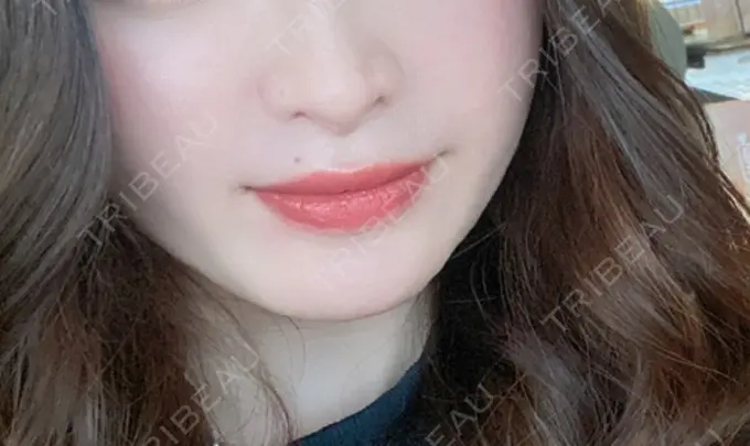 隆鼻術 / 鼻中隔延長（切開） / 鼻修正 / 鼻孔縁下降 / その他（鼻） みずほクリニック BEFORE メイン用