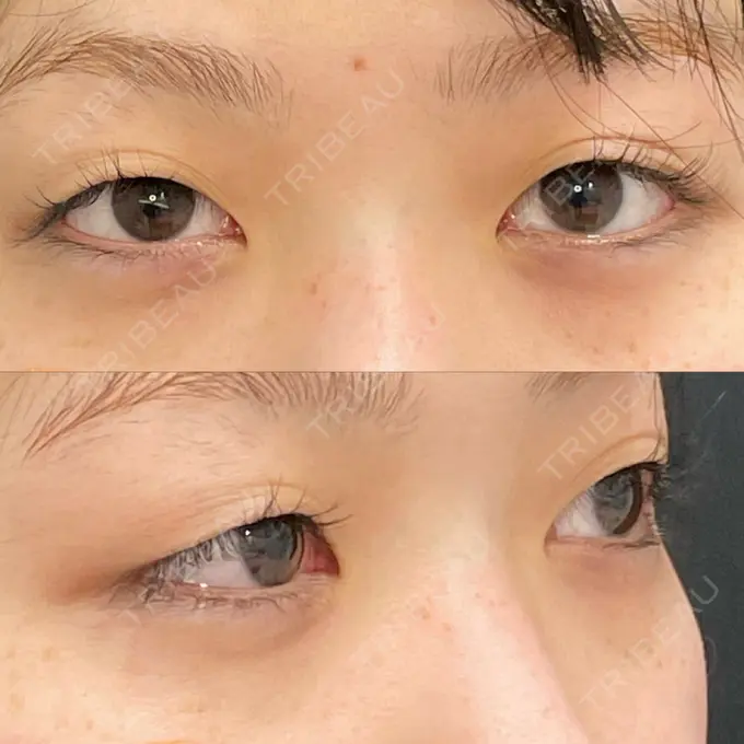 二重埋没 / シワ取りボトックス ルラ美容クリニック 渋谷本院 BEFORE メイン用