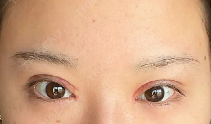 アートメイク（眉） APスキンクリニック銀座 BEFORE メイン用