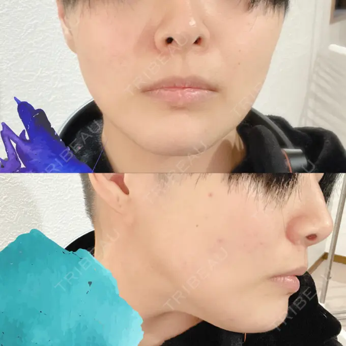 鼻中隔延長（切開） みずほクリニック BEFORE メイン用