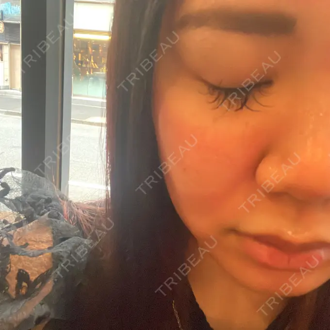 ヴェルヴェットスキン 銀座美容外科クリニック 銀座院 BEFORE メイン用