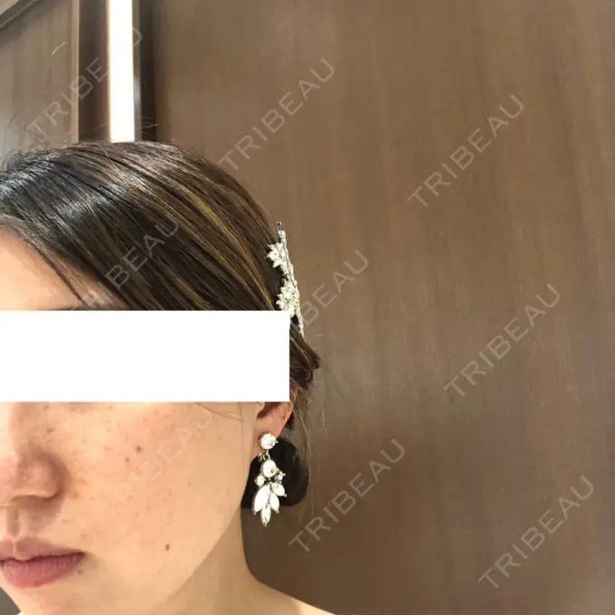 シミ取りレーザー フローラクリニック BEFORE メイン用