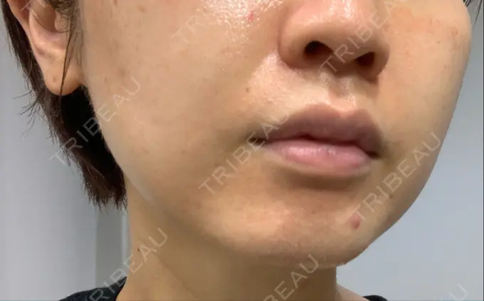 ハイフ（顔） STARS CLINIC BEFORE メイン用