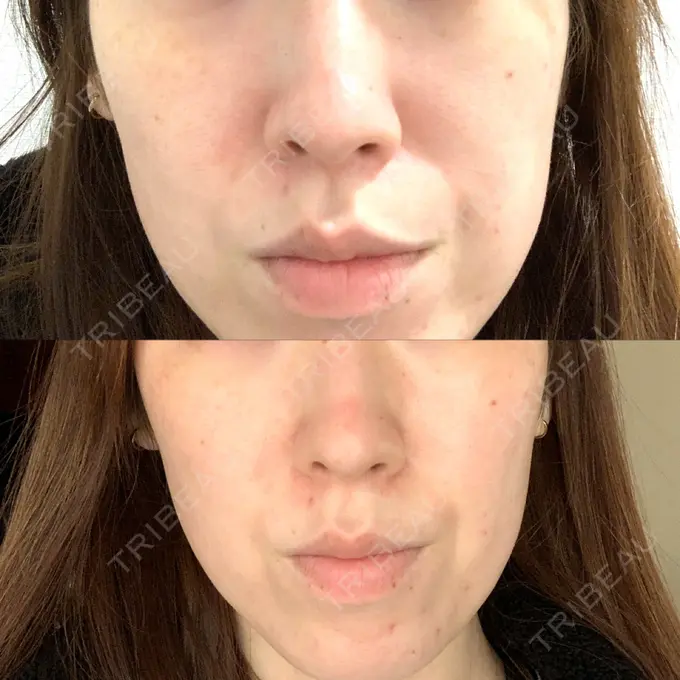 ピーリング（ハリ・ツヤ） ルラ美容クリニック 大宮院 / ルラスキンクリニック 大宮院 BEFORE メイン用