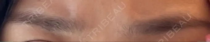 ボトックス（眉間） ルラ美容クリニック 池袋院 BEFORE メイン用