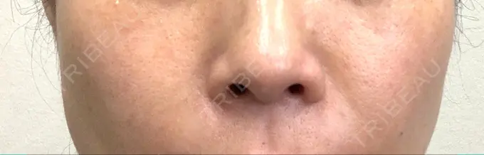 ヒアルロン酸注入（唇） / レーザートーニング（美白・肝斑） 渋谷美容外科クリニック 新橋院 BEFORE メイン用