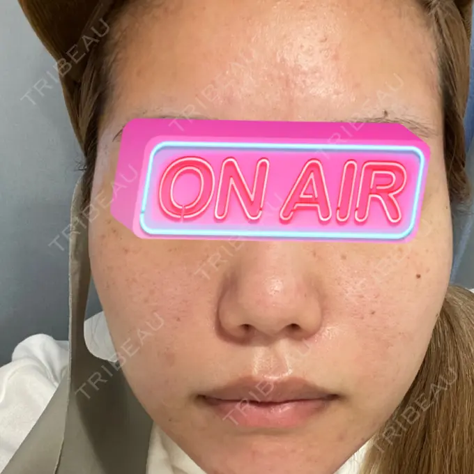 ヴェルヴェットスキン アリエル美容クリニック 大宮院 BEFORE メイン用