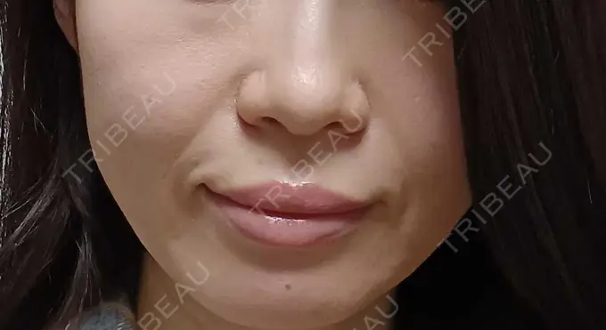 肌ヒアルロン酸注入（たるみ・シワ改善） 恵聖会クリニック 京橋院 BEFORE メイン用