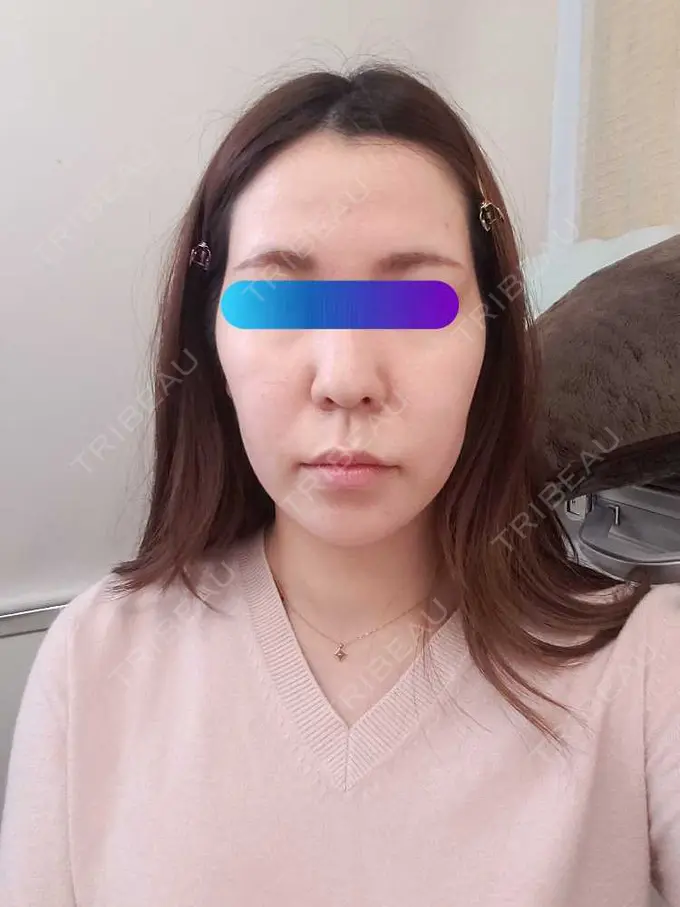 ヒアルロン酸注入（頬） / ヒアルロン酸注入（こめかみ） 加藤クリニック 麻布東京院 BEFORE メイン用