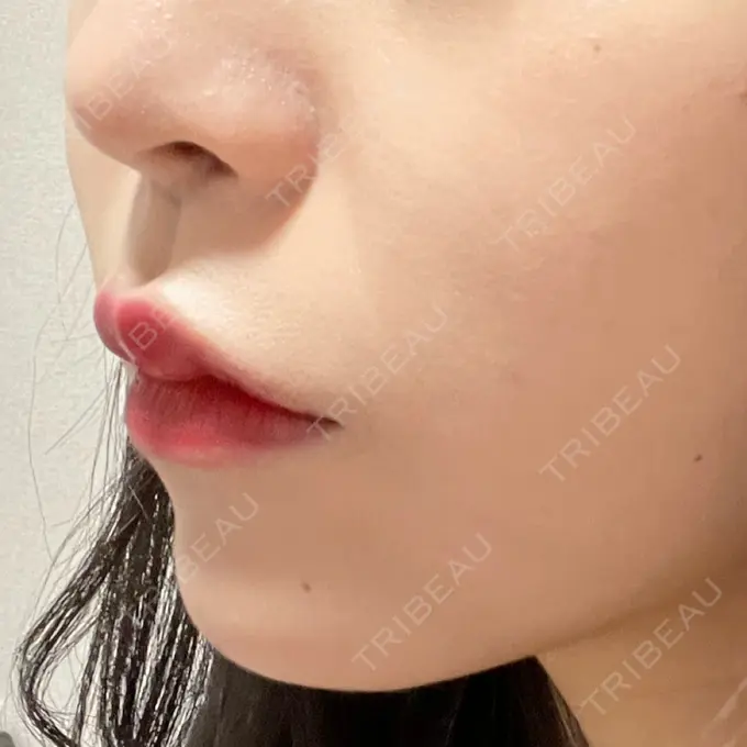 ボトックス（人中） AILE Clinic BEFORE メイン用