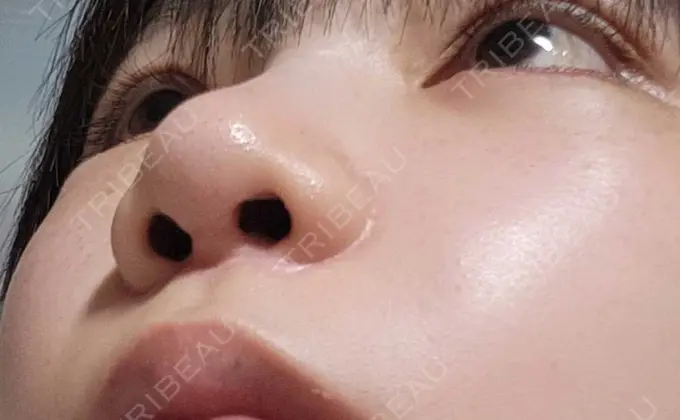 小鼻縮小（切開） くさのたろうクリニック BEFORE メイン用