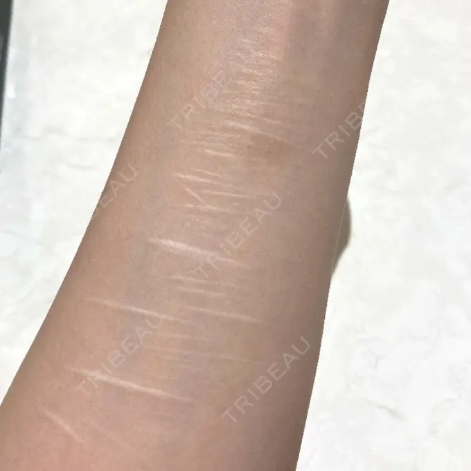 その他 / 傷跡修正 シンデレラ＆ダヴィンチクリニック BEFORE メイン用