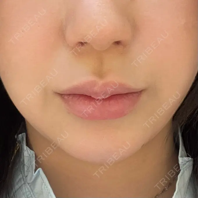 ヒアルロン酸注入（唇） / ボトックス（口角） ルラ美容クリニック 大阪本院 BEFORE メイン用