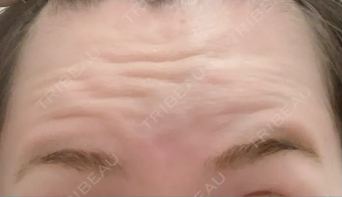 ボトックス（額） 湘南美容クリニック 大阪あべの院 BEFORE メイン用