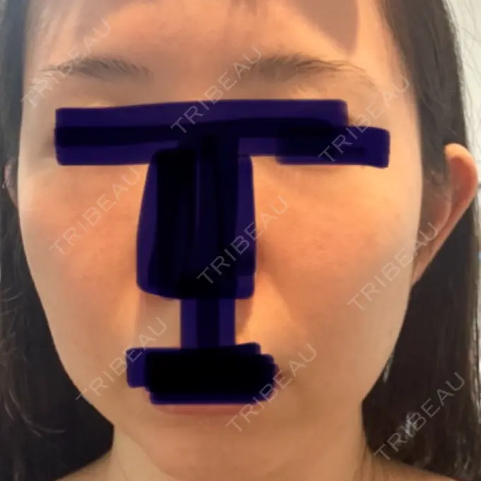 ハイフ（顔） 湘南美容クリニック 大阪あべの院 BEFORE メイン用