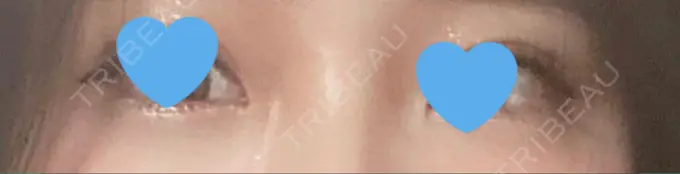 ヒアルロン酸注入（涙袋） フィラークリニック 名古屋栄院 BEFORE メイン用