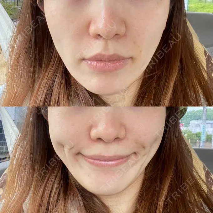 メーラーファット除去 ガーデンクリニック 名古屋院 BEFORE メイン用