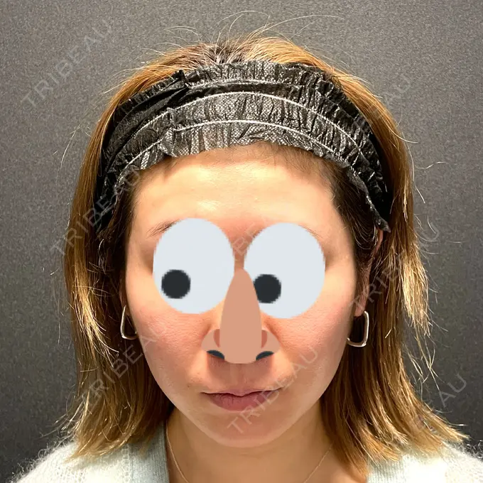 肌ヒアルロン酸注入（たるみ・シワ改善） / ヒアルロン酸注入（あご） / ボトックス（エラ・小顔） X CLINIC 恵比寿院 BEFORE メイン用