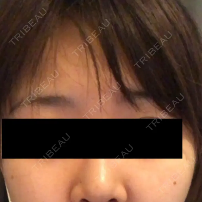 ピコレーザートーニング（美白・肝斑） B-LINE CLINIC 池袋院 BEFORE メイン用