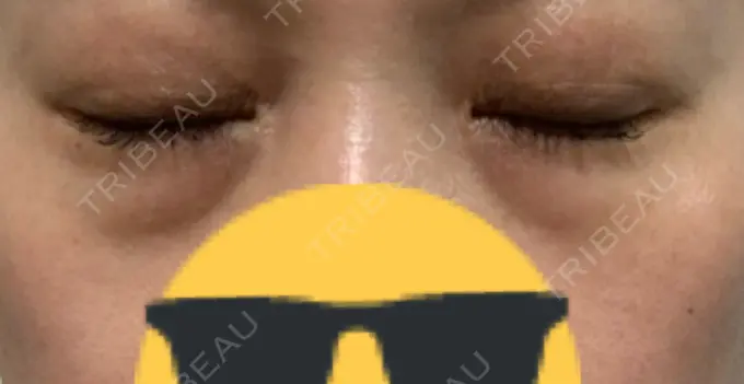 ヒアルロン酸注入（目の下） 渋谷美容外科クリニック 渋谷院 BEFORE メイン用