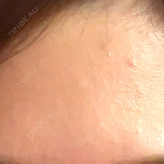 光治療（フォトフェイシャルなど） 渋谷美容外科クリニック 新橋院 BEFORE メイン用